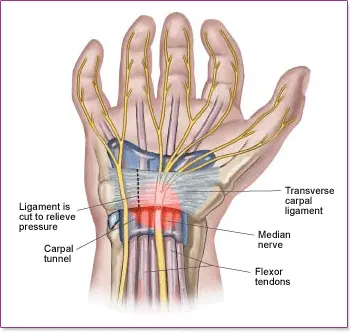 carpal-tunnel-ligament